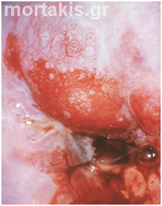 HPV - HSIL