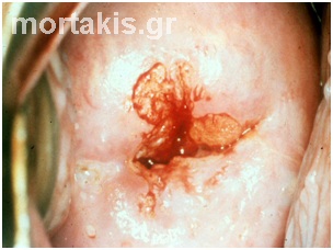HPV - cervix
