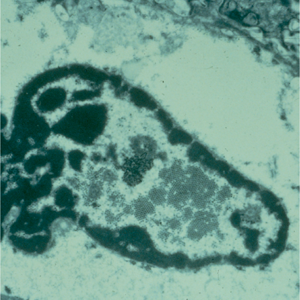 κύτταρο HPV