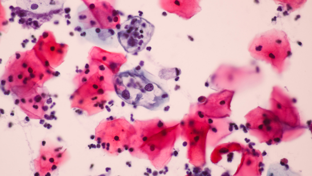 “Abnormal cells” on Pap smear: what is the next step?