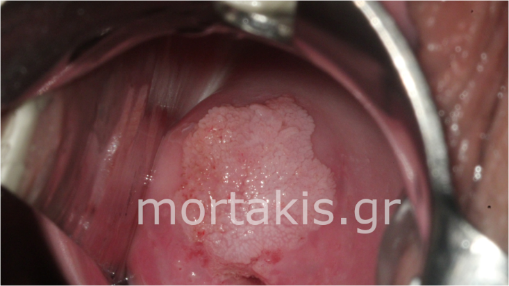 CERVICAL WART, ΚΟΝΔΥΛΩΜΑ ΤΡΑΧΗΛΟΥ ΜΗΤΡΑΣ