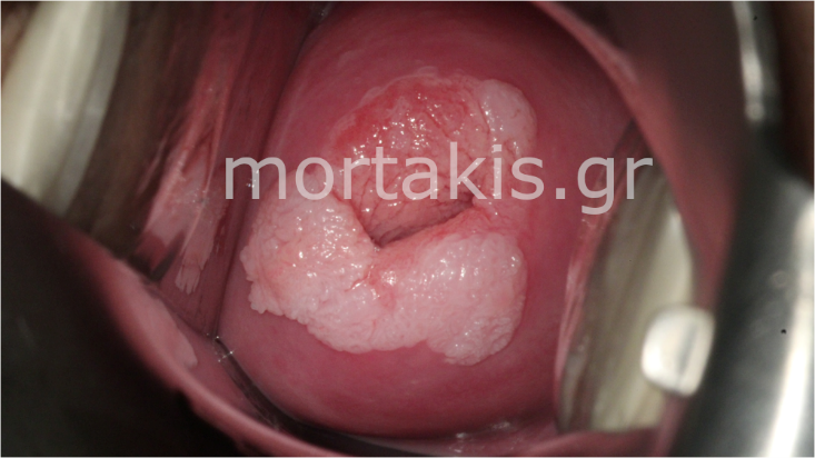 CERVICAL WART, ΚΟΝΔΥΛΩΜΑ ΤΡΑΧΗΛΟΥ ΜΗΤΡΑΣ