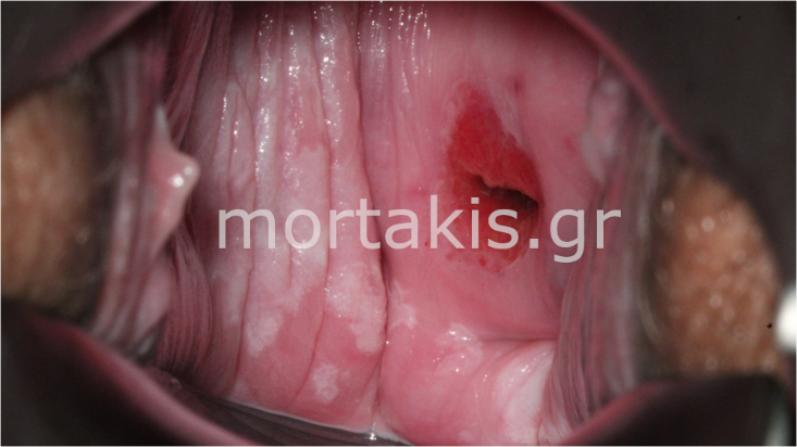 VAIN2, VAIN3, HSIL VAGINAL